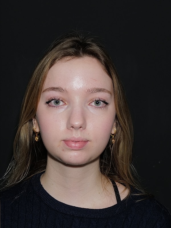 Chin Implant Before & After