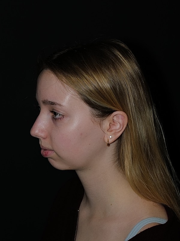 Chin Implant Before & After