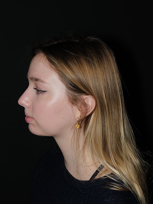 Chin Implant Before & After