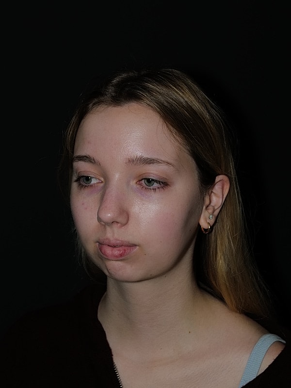 Chin Implant Before & After