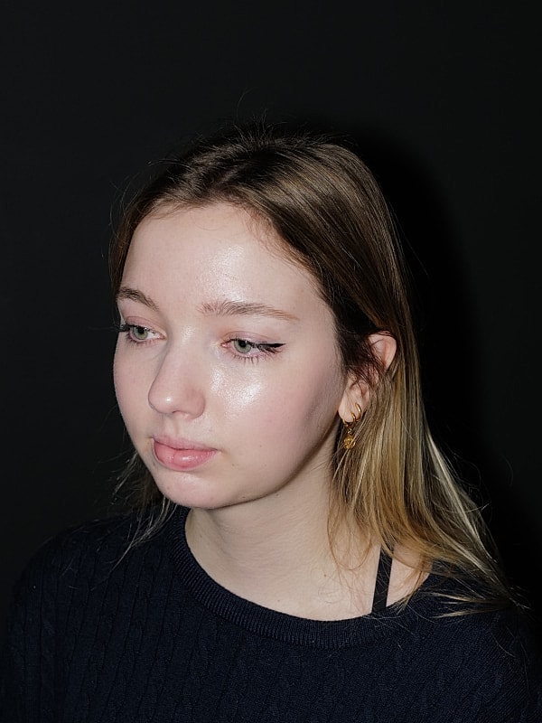 Chin Implant Before & After
