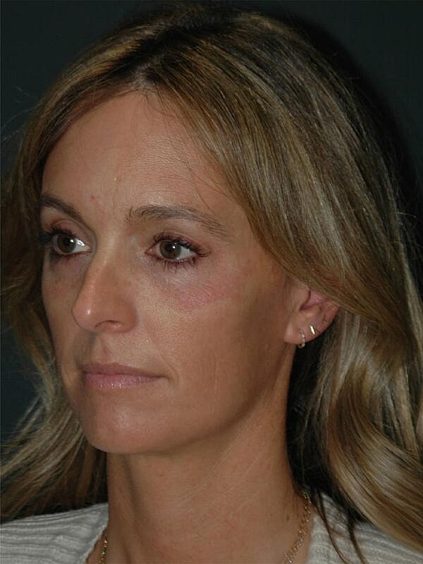 Tear Trough Filler Before & After