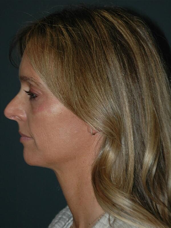 Tear Trough Filler Before & After