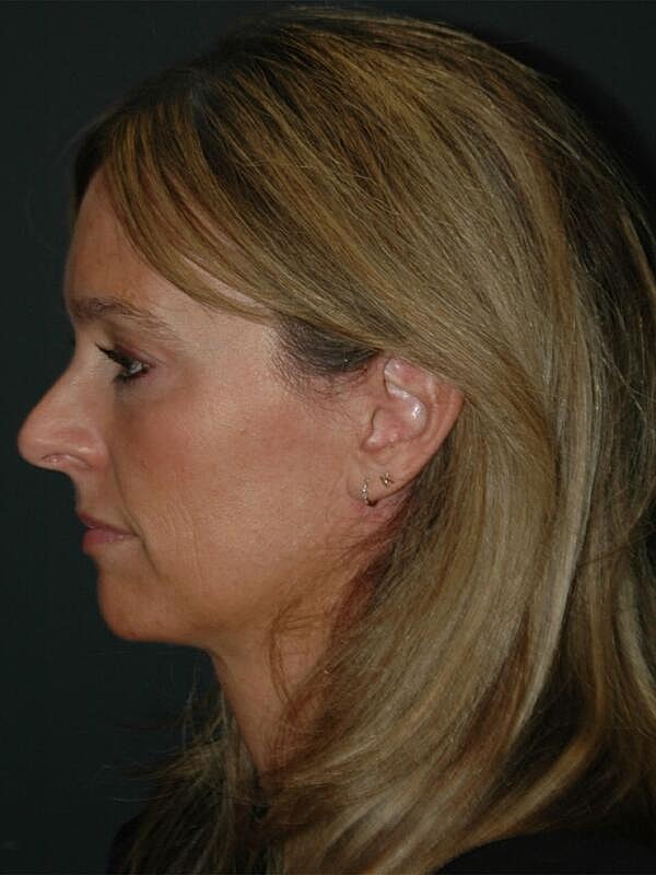 Tear Trough Filler Before & After