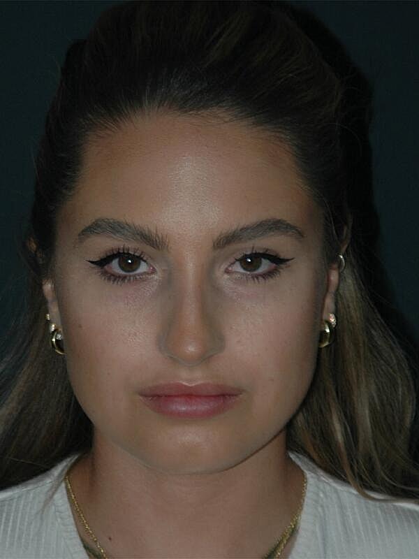 Tear Trough Filler Before & After