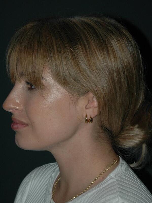 Tear Trough Filler Before & After