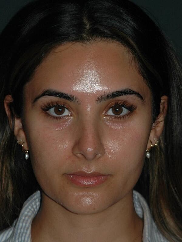 Tear Trough Filler Before & After