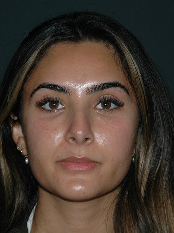 Tear Trough Filler Before & After