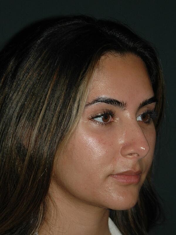 Tear Trough Filler Before & After