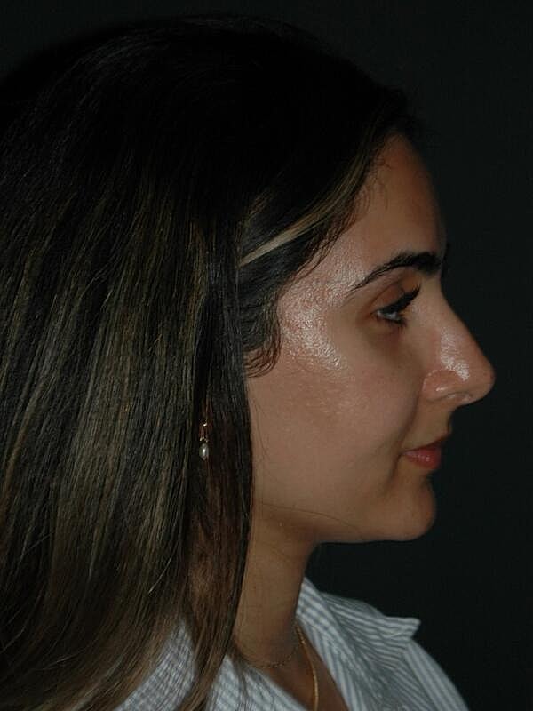 Tear Trough Filler Before & After