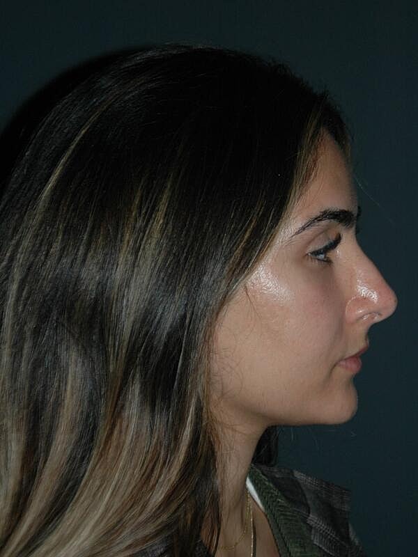 Tear Trough Filler Before & After