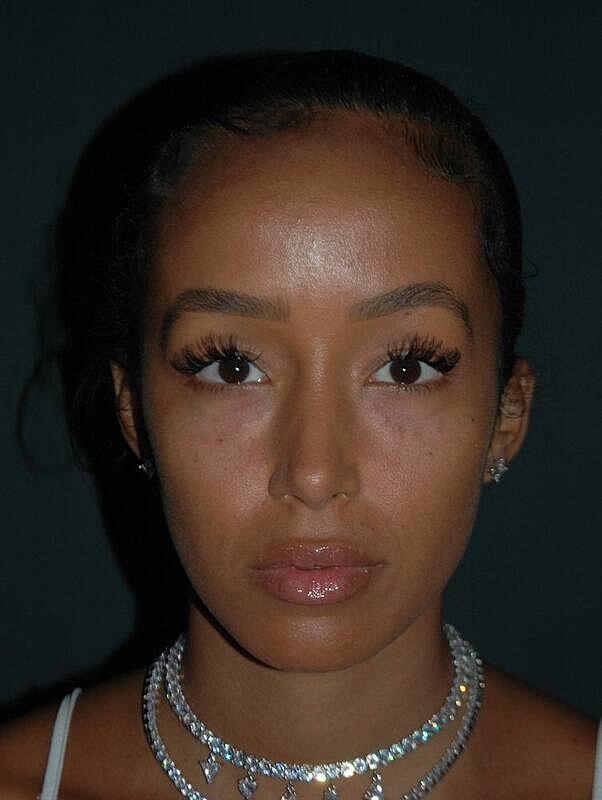 Tear Trough Filler Before & After
