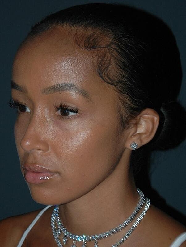 Tear Trough Filler Before & After