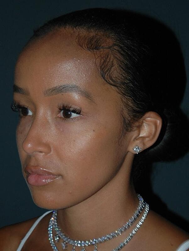 Tear Trough Filler Before & After