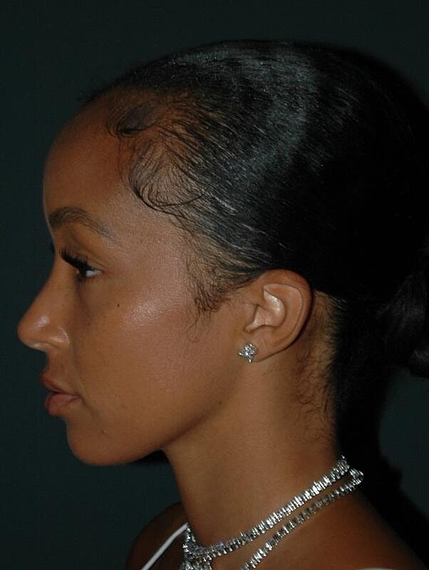 Tear Trough Filler Before & After