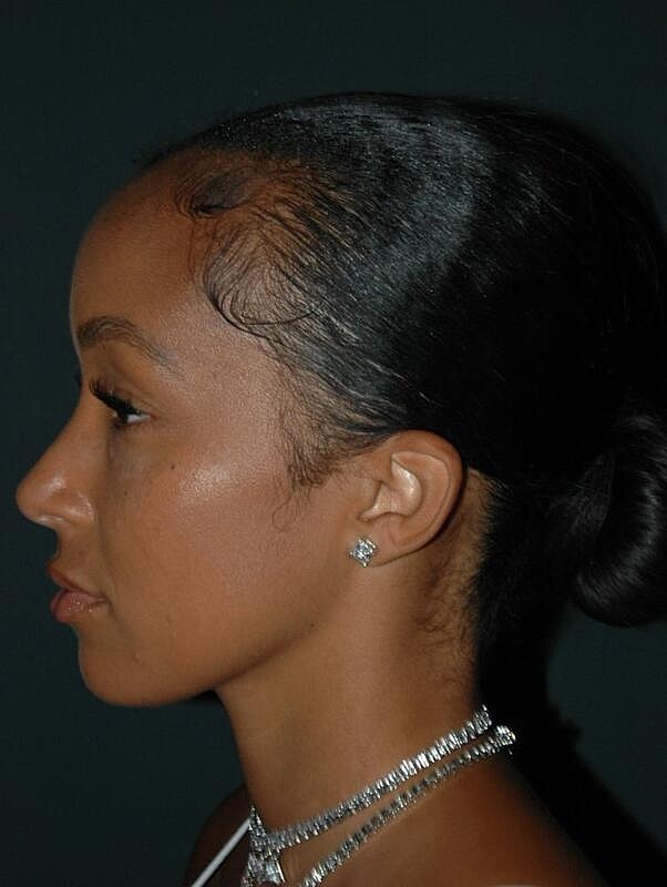 Tear Trough Filler Before & After