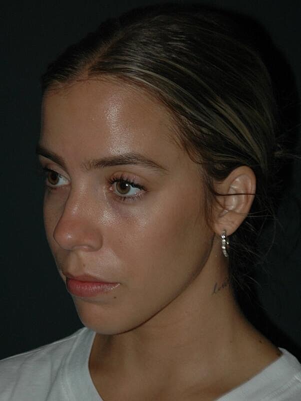 Tear Trough Filler Before & After