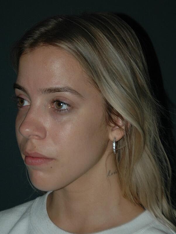 Tear Trough Filler Before & After