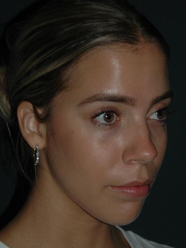 Tear Trough Filler Before & After