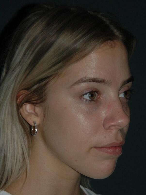 Tear Trough Filler Before & After
