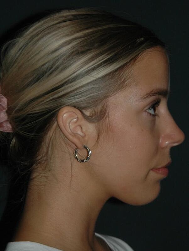 Tear Trough Filler Before & After