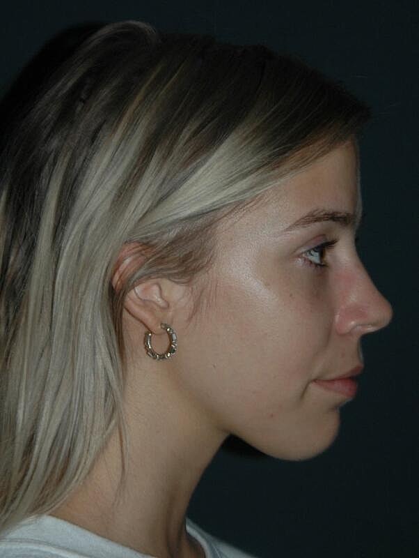 Tear Trough Filler Before & After