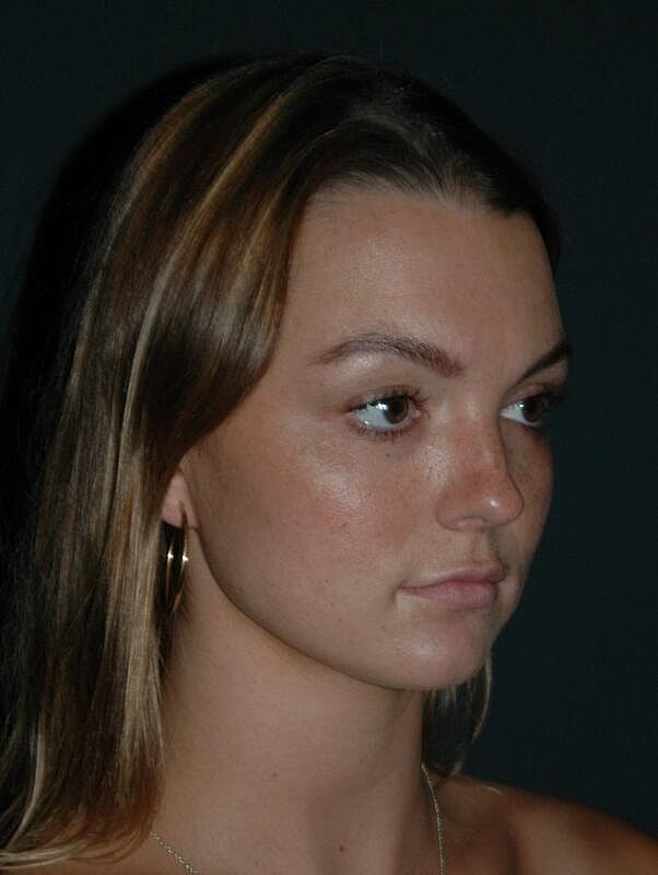 Tear Trough Filler Before & After