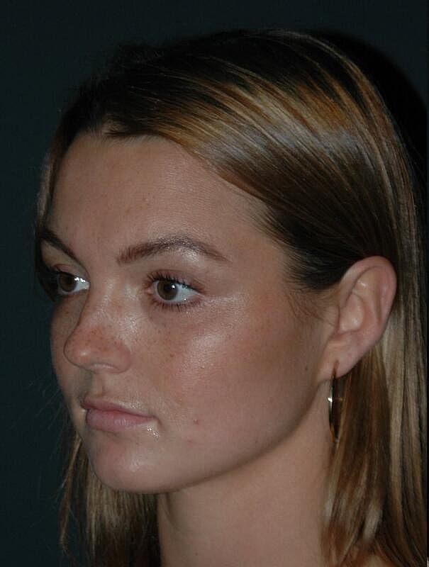 Tear Trough Filler Before & After