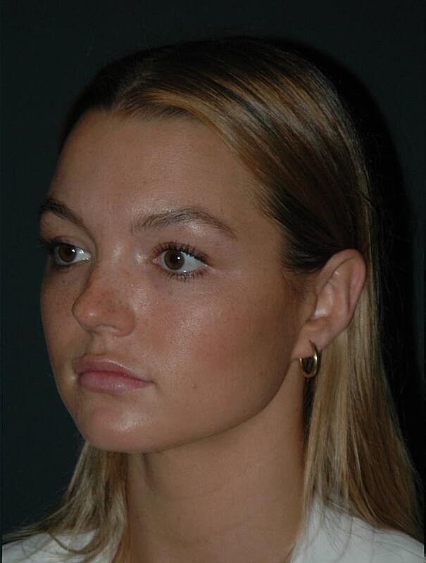 Tear Trough Filler Before & After