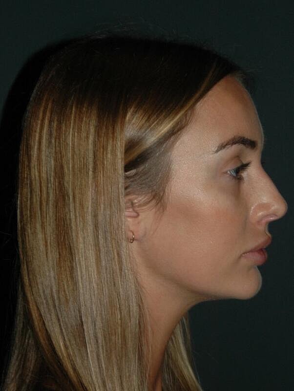 Tear Trough Filler Before & After