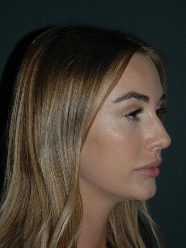 Tear Trough Filler Before & After