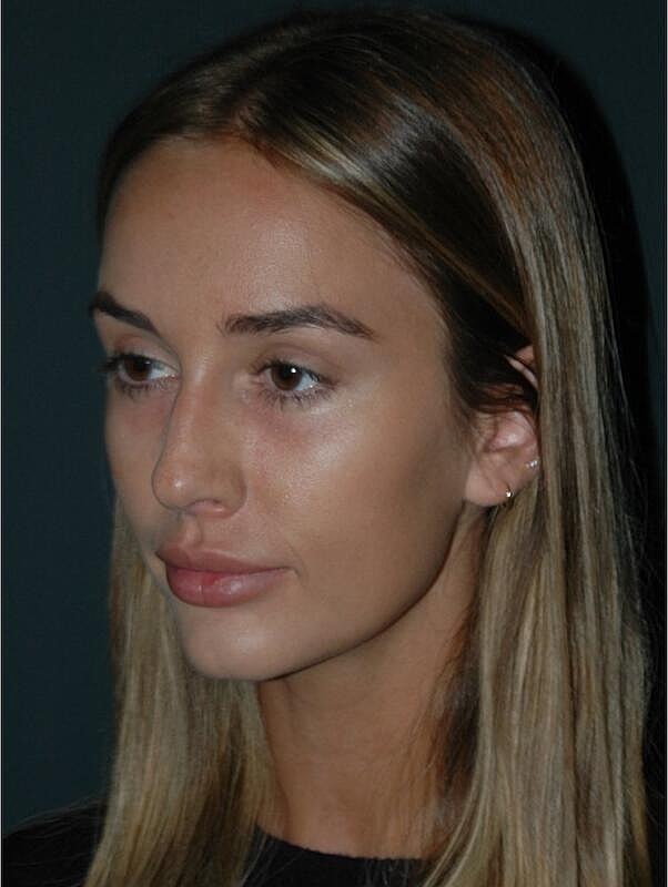 Tear Trough Filler Before & After