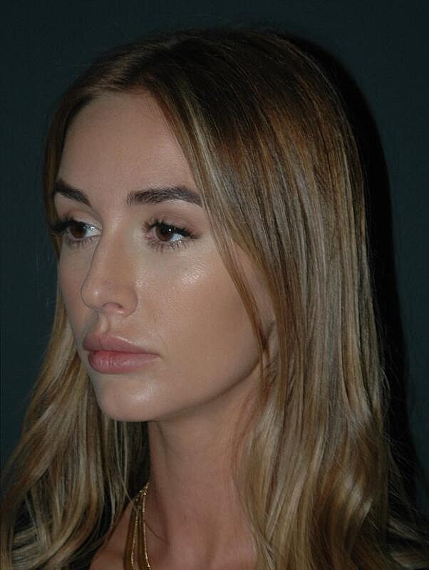 Tear Trough Filler Before & After