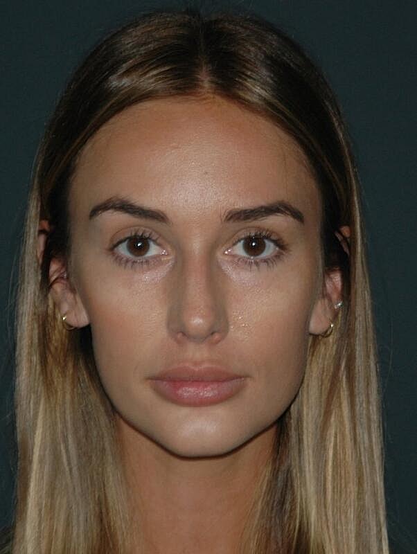 Tear Trough Filler Before & After