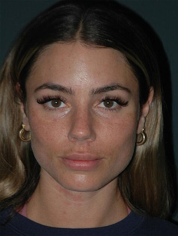 Tear Trough Filler Before & After