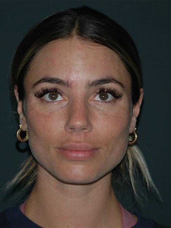 Tear Trough Filler Before & After