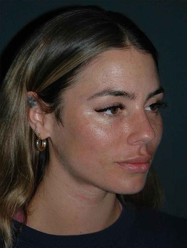 Tear Trough Filler Before & After