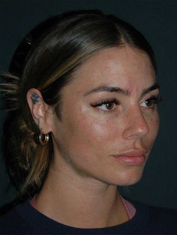 Tear Trough Filler Before & After