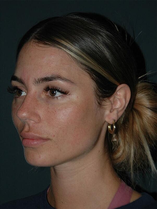 Tear Trough Filler Before & After