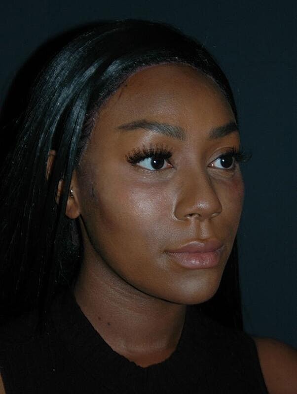 Tear Trough Filler Before & After