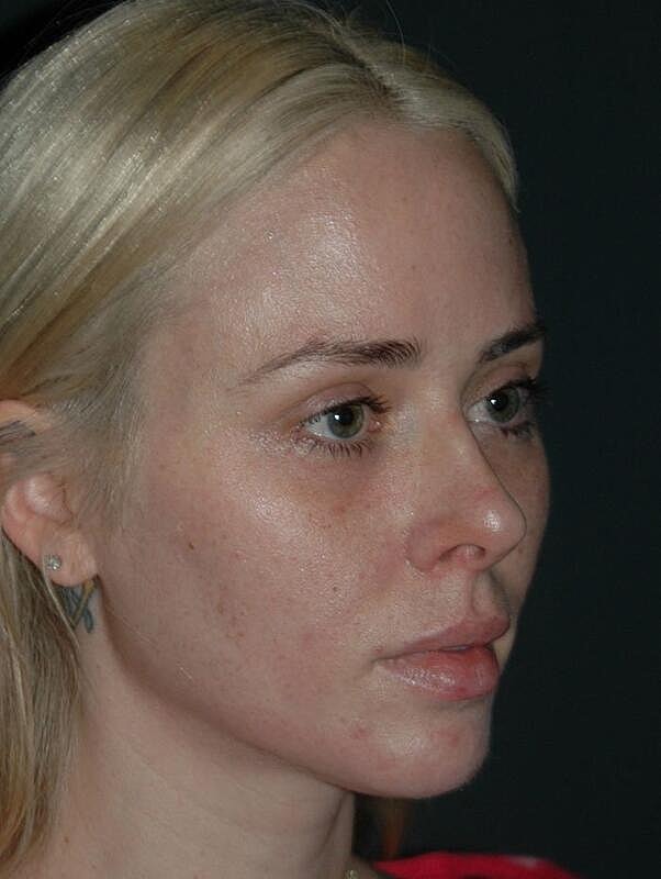 Tear Trough Filler Before & After