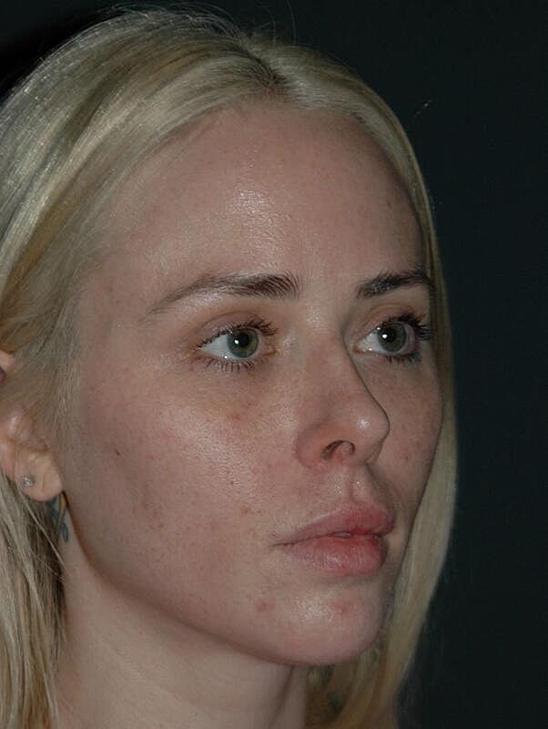 Tear Trough Filler Before & After