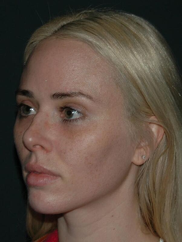 Tear Trough Filler Before & After