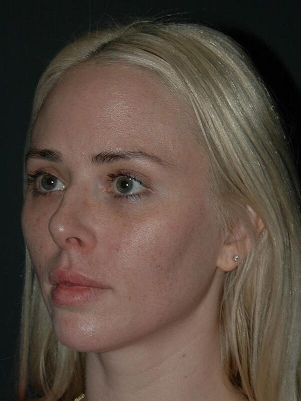 Tear Trough Filler Before & After