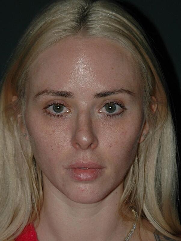 Tear Trough Filler Before & After