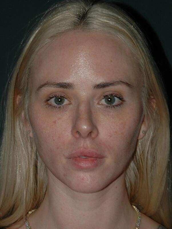 Tear Trough Filler Before & After