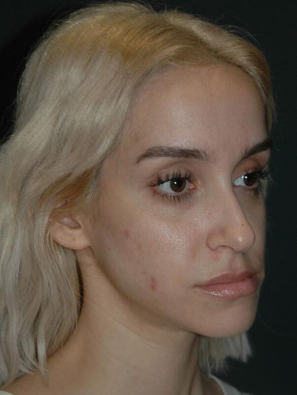 Tear Trough Filler Before & After