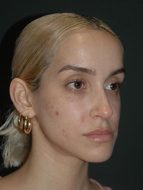 Tear Trough Filler Before & After
