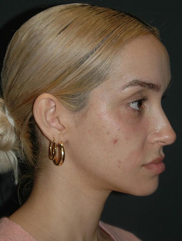 Tear Trough Filler Before & After