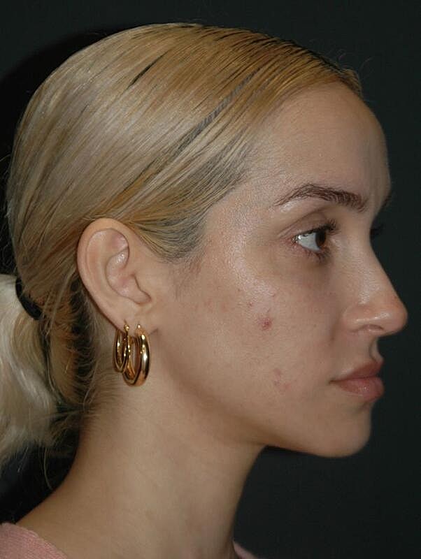 Tear Trough Filler Before & After